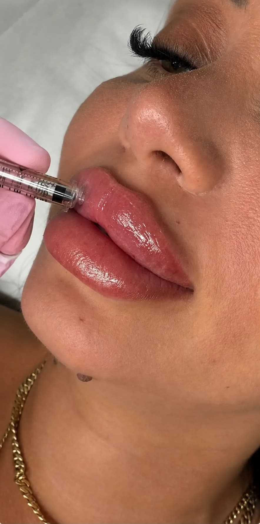 Hyaluron Pen Revolax sau Stylage